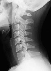 正常な頸椎のレントゲン写真